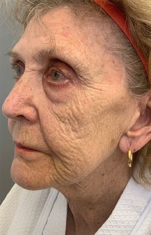 Before Image: Laser Resurfacing - left-front-oblique