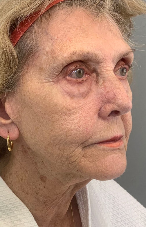 Before Image: Laser Resurfacing - right-front-oblique