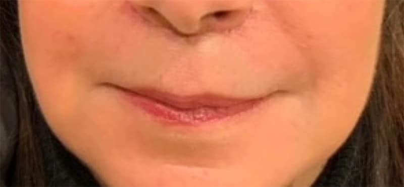 After Image: Lip Lift - front