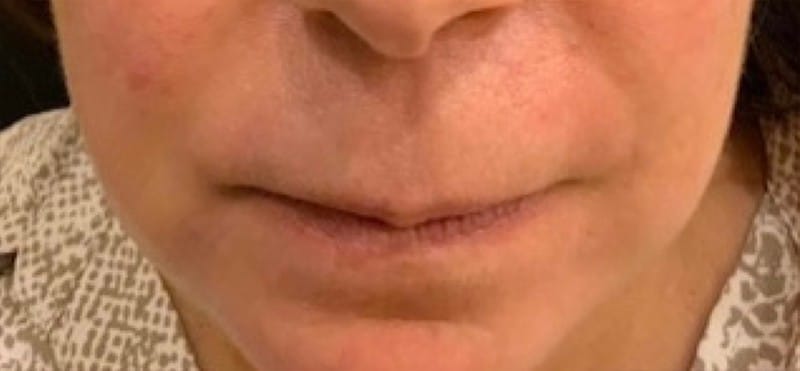 Before Image: Lip Lift - front