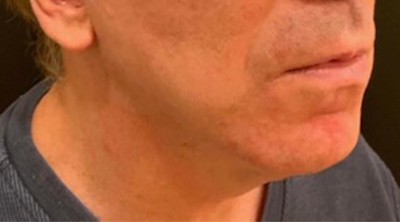 After Image: Lip Lift - right-front-oblique