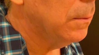 Before Image: Lip Lift - right-front-oblique