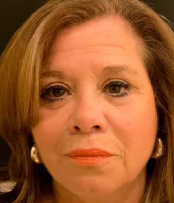 After Image: Lip Lift - front