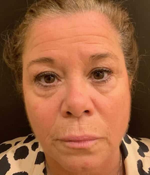 Before Image: Lip Lift - front
