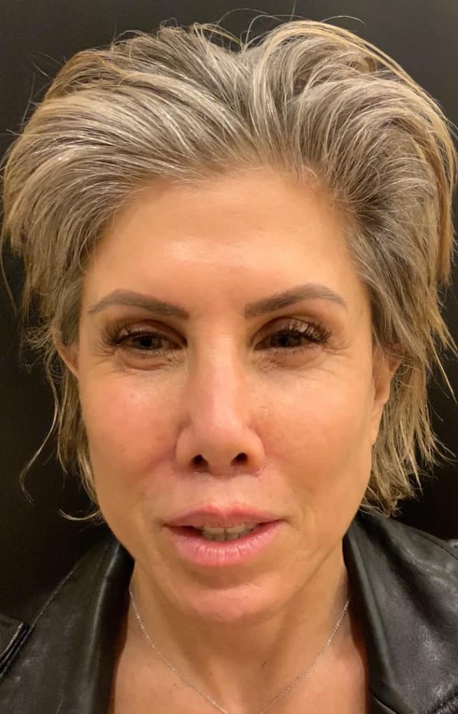 After Image: Lip Lift - front