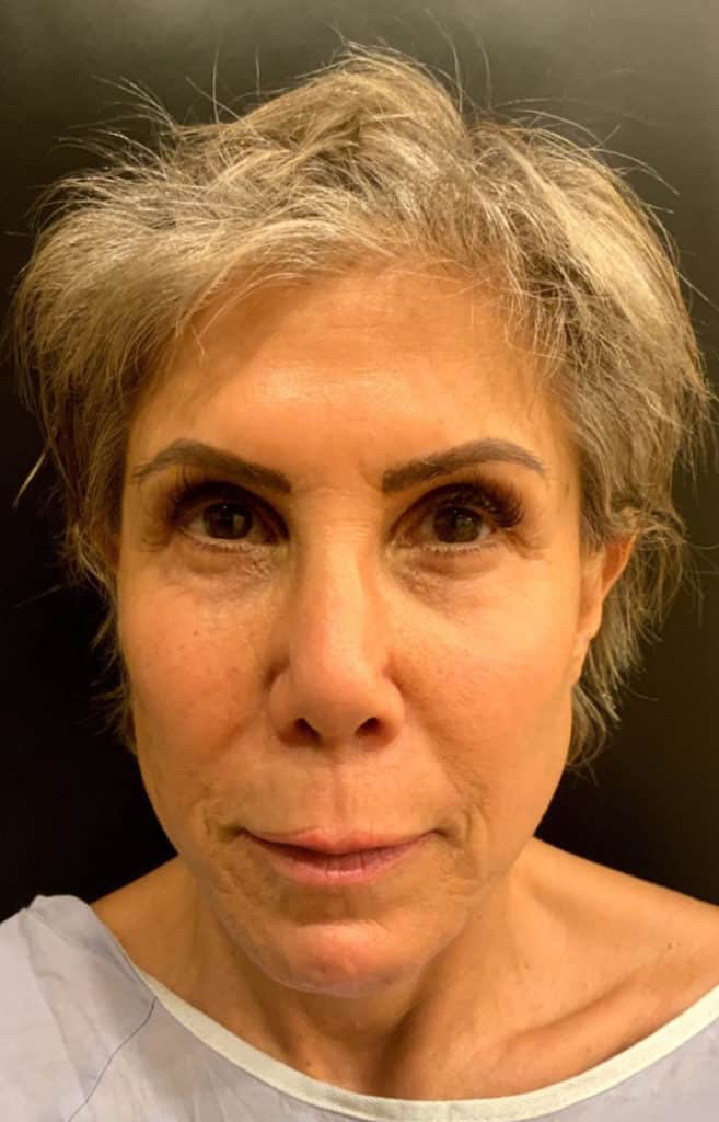 Before Image: Lip Lift - front