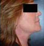 After Image: Liposuction - right-side