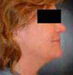 Before Image: Liposuction - right-side