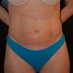 After Image: Liposuction - front