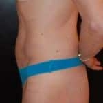 After Image: Liposuction - left-side