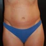 Before Image: Liposuction - front