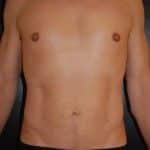After Image: Liposuction - front