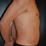 After Image: Liposuction - right-side