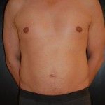 Before Image: Liposuction - front