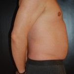 Before Image: Liposuction - right-side