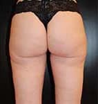 After Image: Liposuction - back