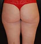 Before Image: Liposuction - back