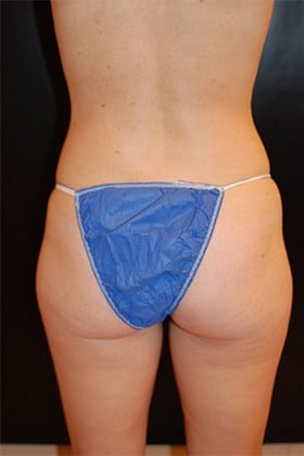 Before Image: Liposuction - back