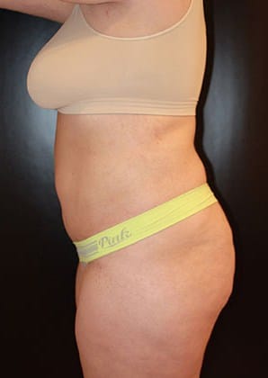 After Image: Liposuction - left-side