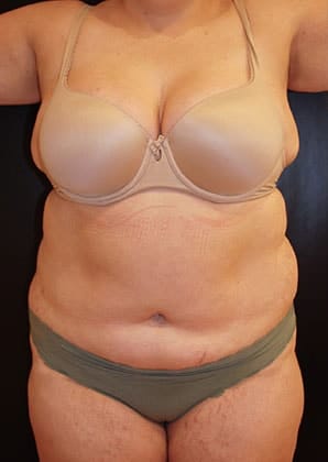 Before Image: Liposuction - front