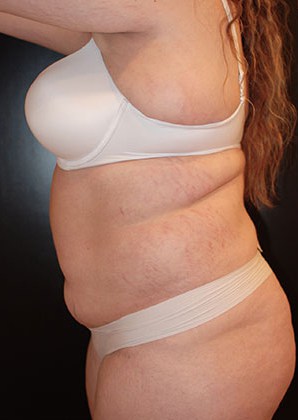 Before Image: Liposuction - left-side
