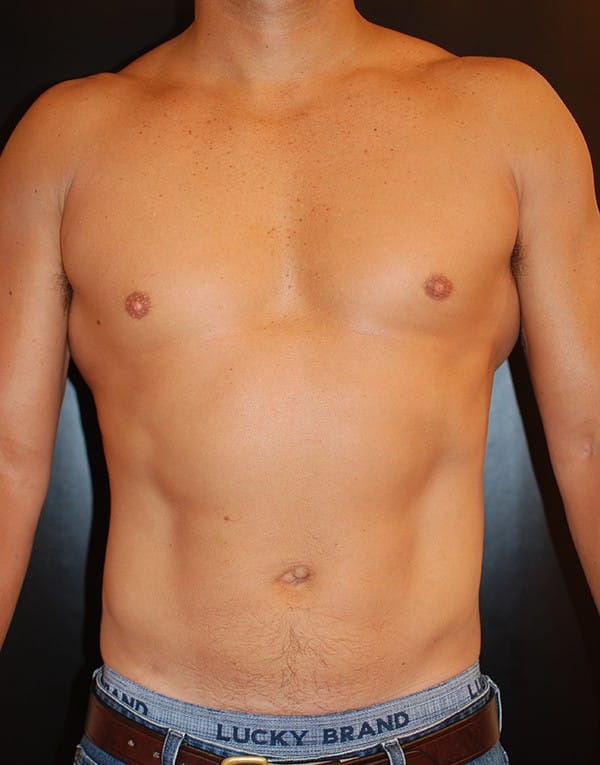 After Image: Liposuction - front