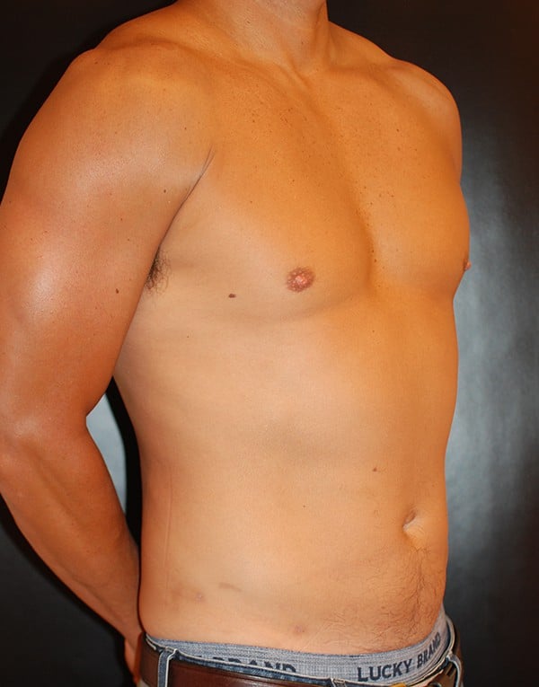 After Image: Liposuction - right-front-oblique