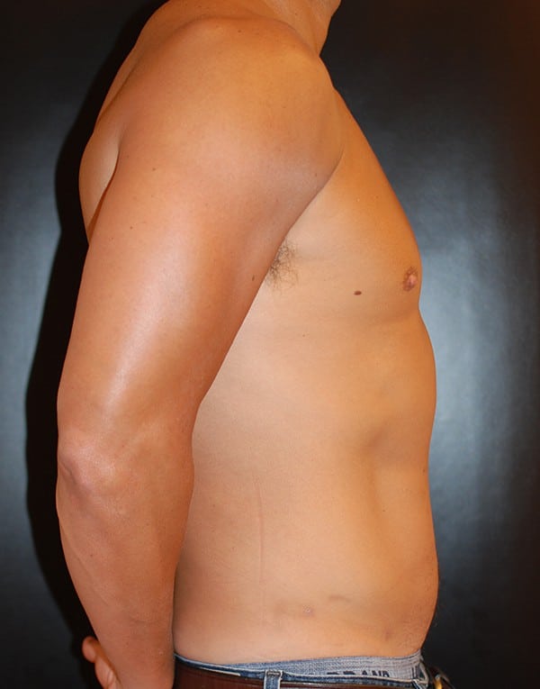 After Image: Liposuction - right-side