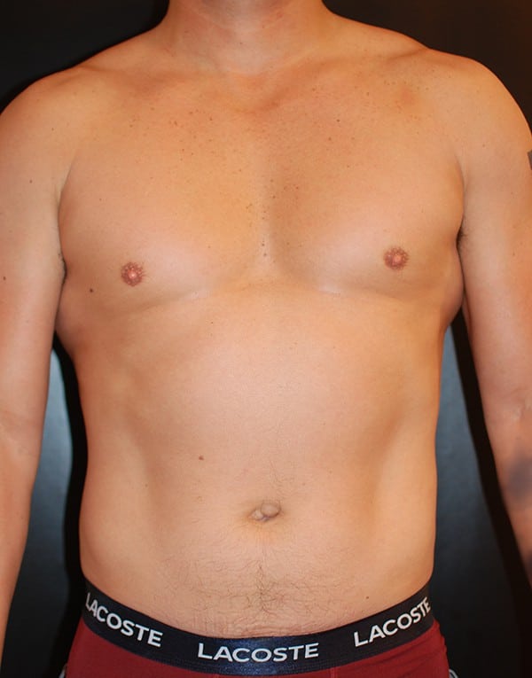 Before Image: Liposuction - front