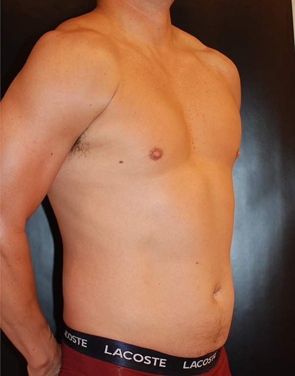 Before Image: Liposuction - right-front-oblique