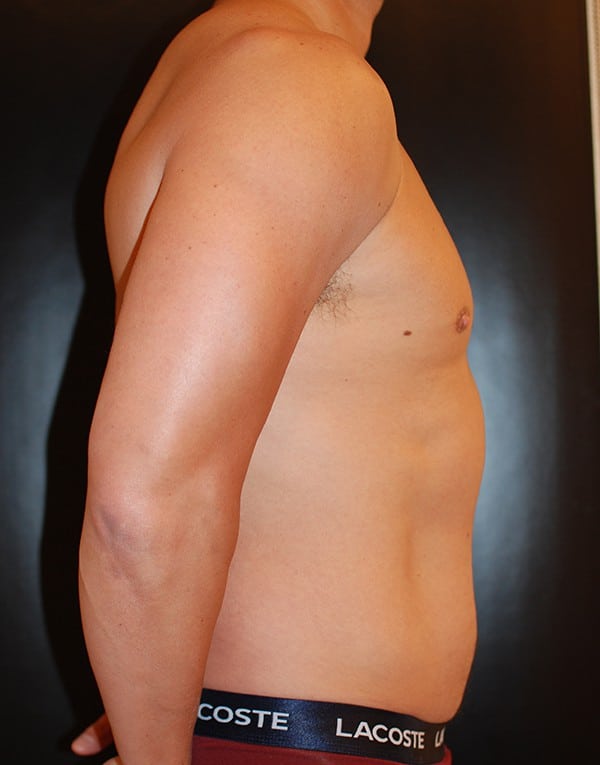 Before Image: Liposuction - right-side