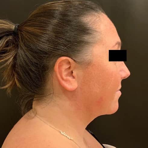 After Image: Liposuction - right-side