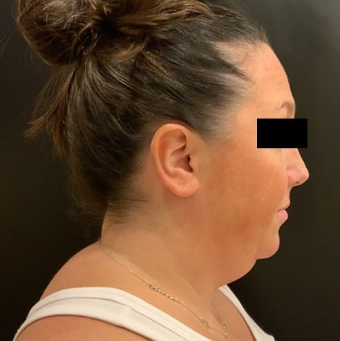 Before Image: Liposuction - right-side