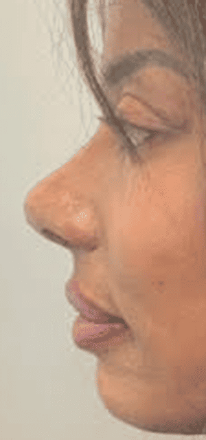 After Image: Liquid Rhinoplasty - left-side