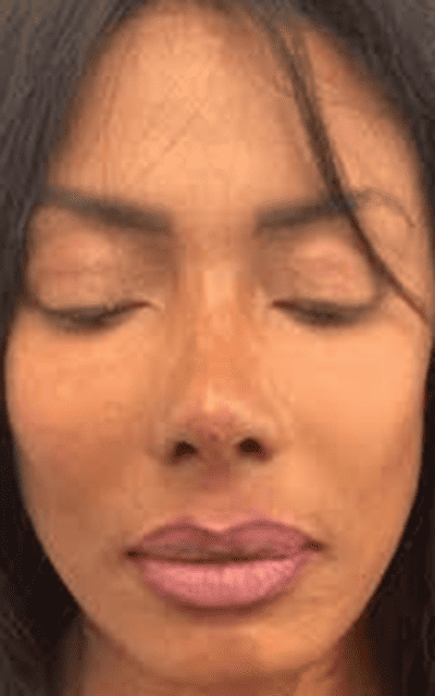 After Image: Liquid Rhinoplasty - front
