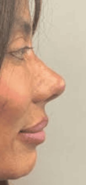 After Image: Liquid Rhinoplasty - left-side