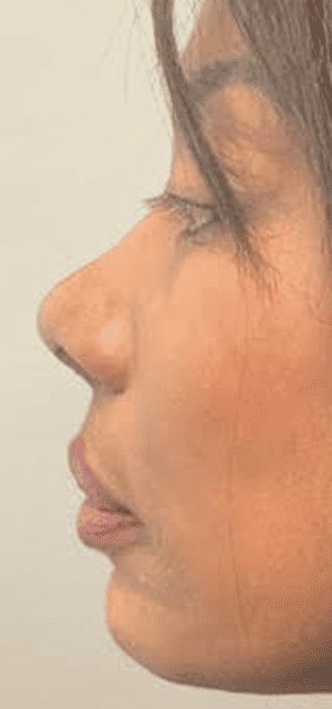 Before Image: Liquid Rhinoplasty - left-side