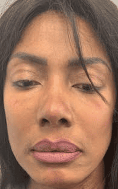 Before Image: Liquid Rhinoplasty - front