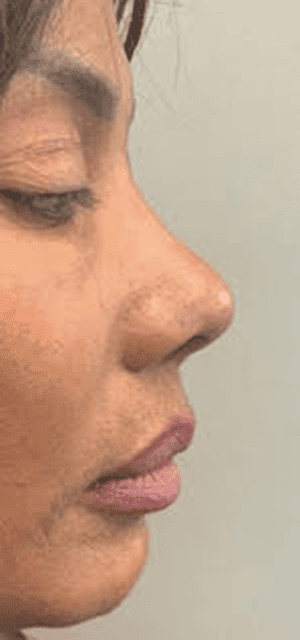 Before Image: Liquid Rhinoplasty - left-side