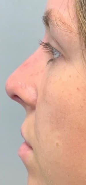 After Image: Liquid Rhinoplasty - left-side