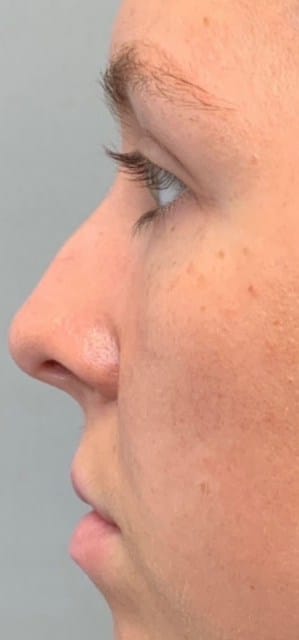 Before Image: Liquid Rhinoplasty - left-side