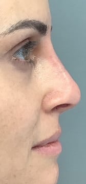After Image: Liquid Rhinoplasty - right-side