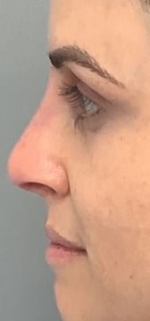 After Image: Liquid Rhinoplasty - left-side
