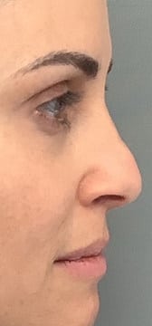 Before Image: Liquid Rhinoplasty - right-side