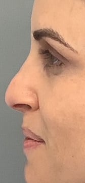 Before Image: Liquid Rhinoplasty - left-side