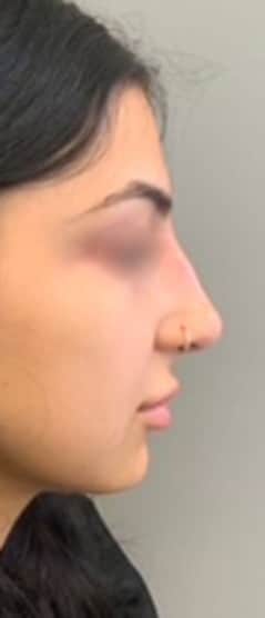 After Image: Liquid Rhinoplasty - right-side