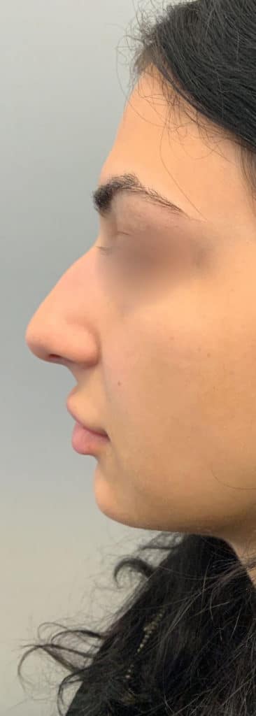 After Image: Liquid Rhinoplasty - left-side