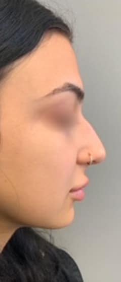 Before Image: Liquid Rhinoplasty - right-side