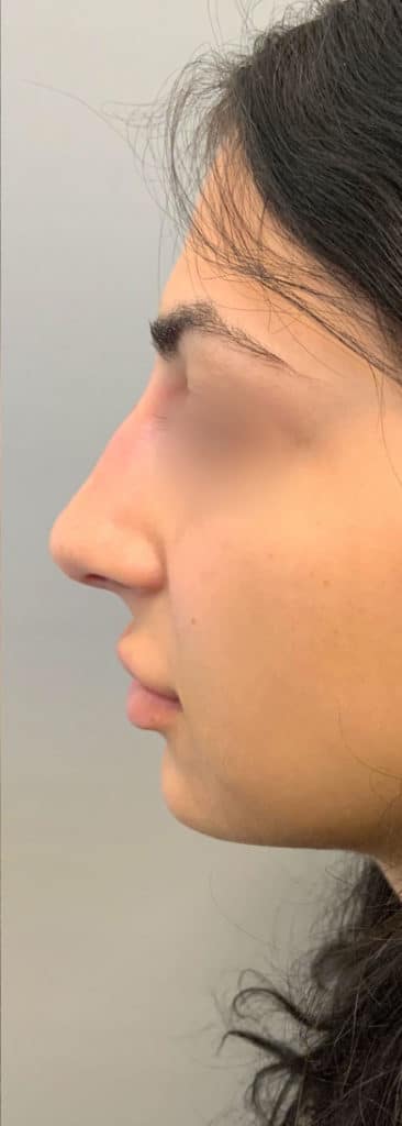 Before Image: Liquid Rhinoplasty - left-side