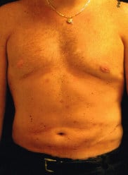 After Image: Male Breast Reduction (Gynecomastia) - front
